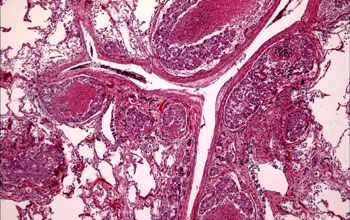 Microscopic images of the lung tumor with intravascular metastases