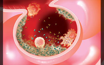 When the immune response is compromised, bacteria colonize the alveoli, forming biofilms