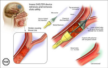 Getting a Grip on Stroke Treatment