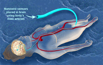 Someday, nanowires routed to the brain through the circulatory system may help patients