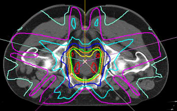 An intensity-modulated radiation therapy (IMRT) planning algorithm